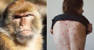 تسجيل بالمغرب حالة إصابة واردة بمرض جدري القردة