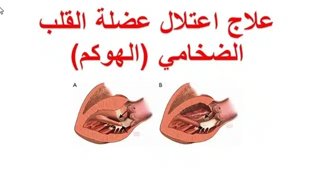 دواء ثوري ينقذ حياة مرضى اعتلال عضلة القلب!